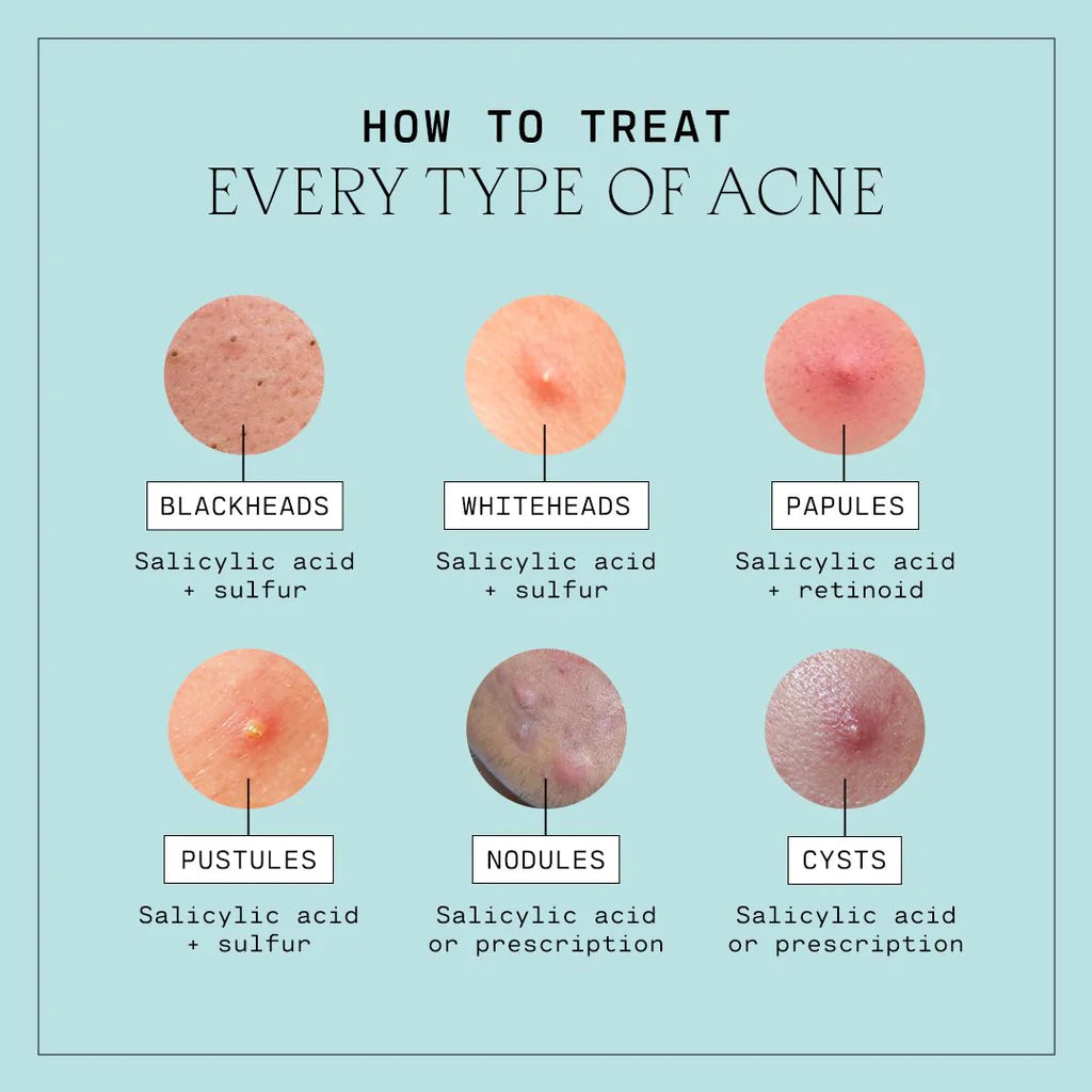 Acne-Aid